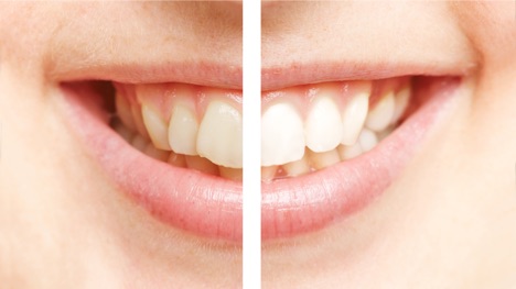 Image of teeth before and after whitening
